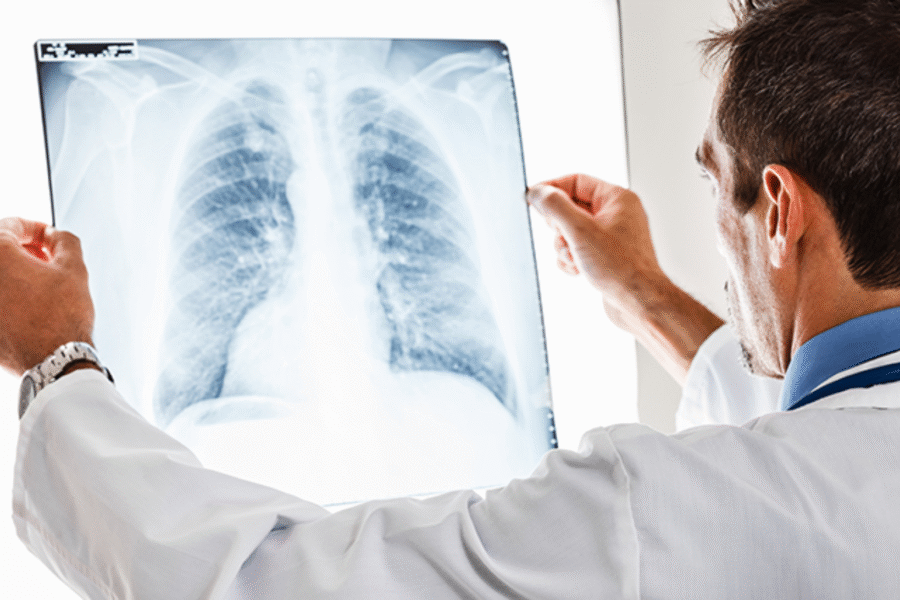 What to Expect During Stage 2 Lung Cancer Treatment: A Beginner’s Guide